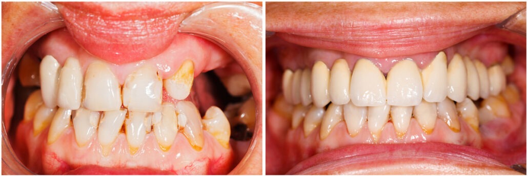 Picture of human teeth before and after dental treatment - beforeafter series.