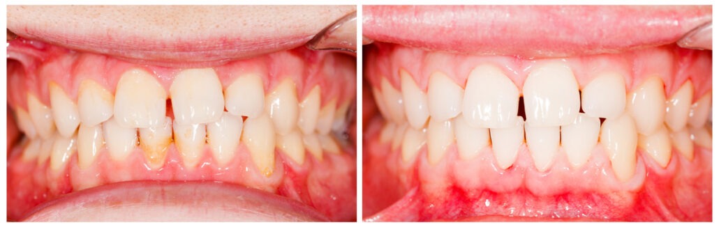 Teeth before and after tooth whitening treatment.