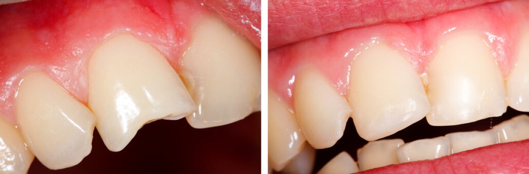 The treatment of a fractured tooth (incisor) - part of Beforeafter series.