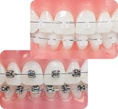 Aparat ortodontyczny 1